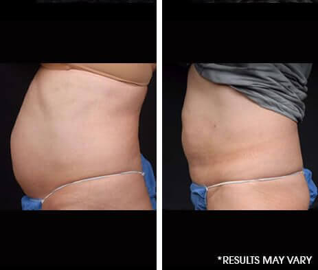 Liposuction Before and After  South Florida Center for Cosmetic